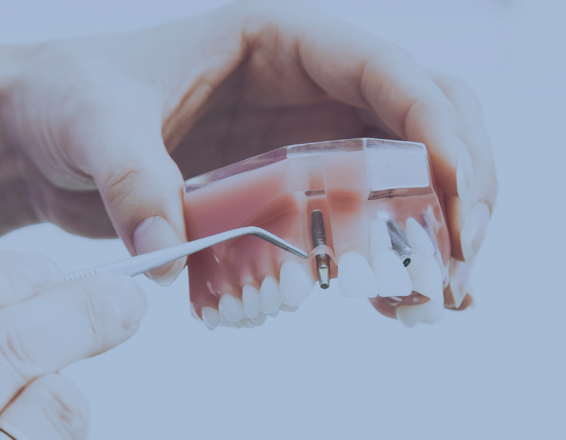 The Pros and Cons of Dental Implants: What You Need To Know